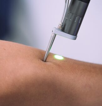 laser treatment