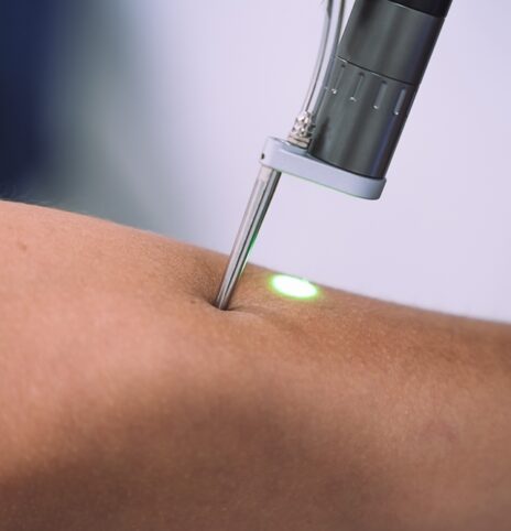 laser treatment