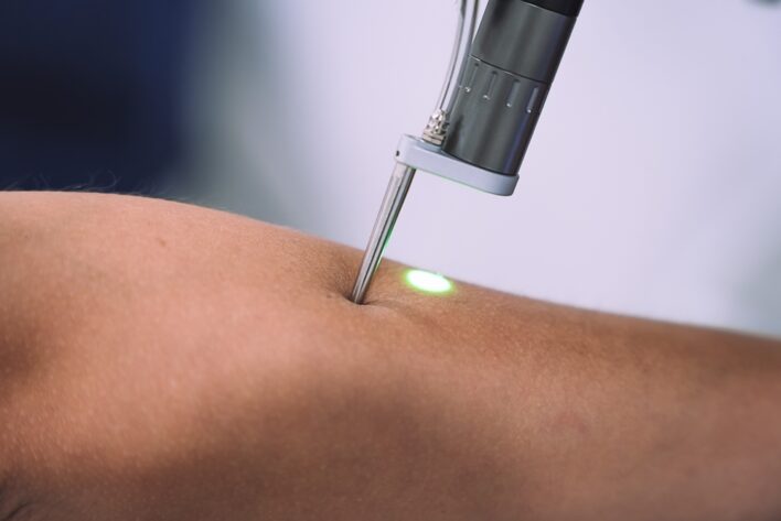 laser treatment